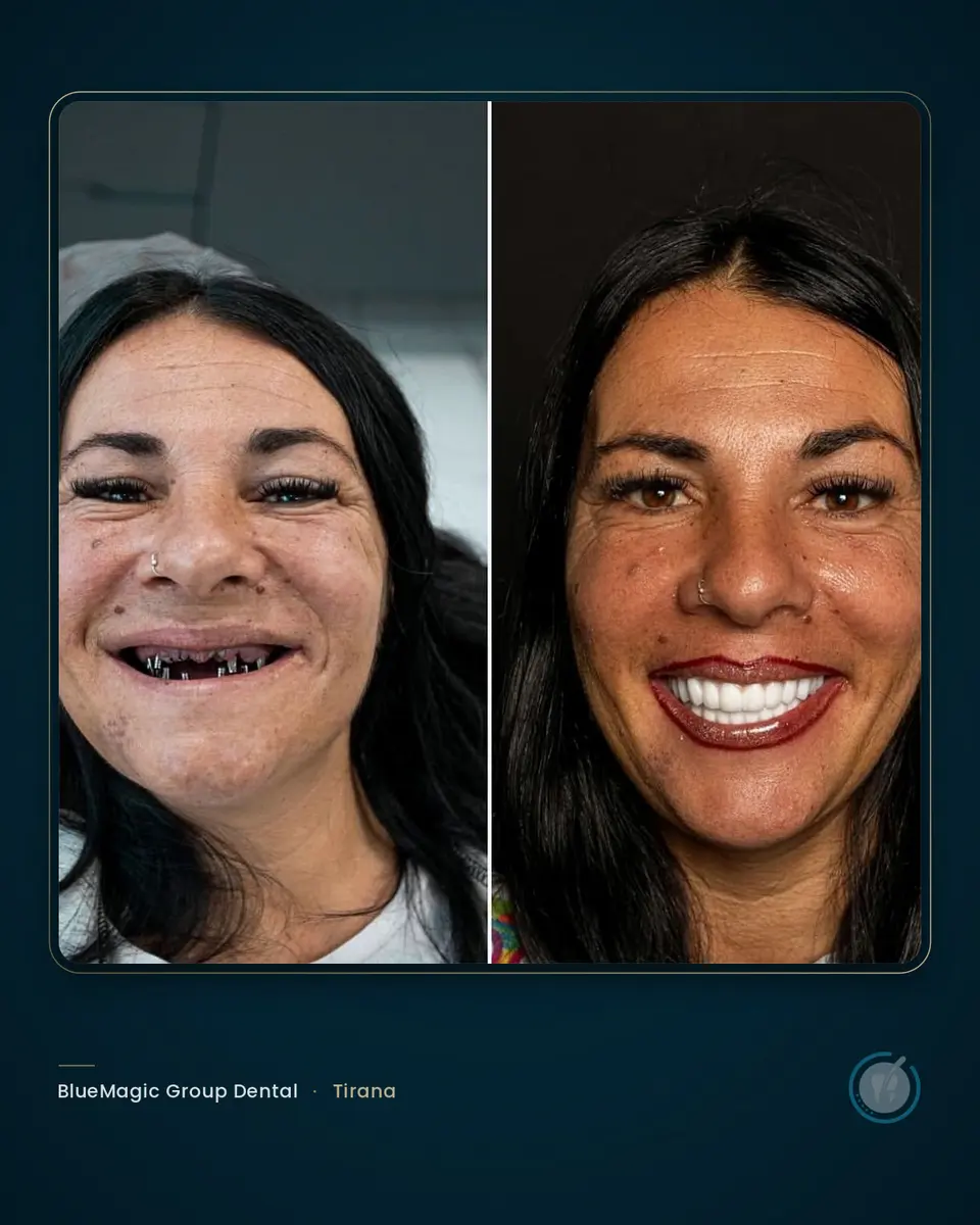 Before and after dental treatment in Albania, real BlueMagic Group Dental patient
