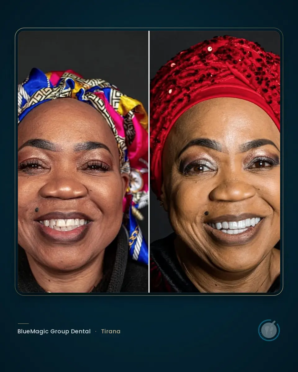Before and after dental treatment in Albania, real BlueMagic Group Dental patient