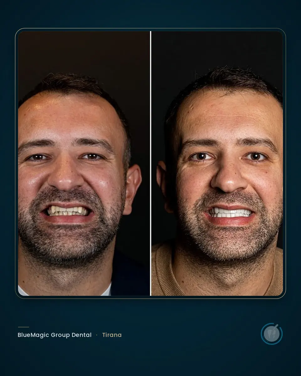 Before and after dental treatment in Albania, real BlueMagic Group Dental patient