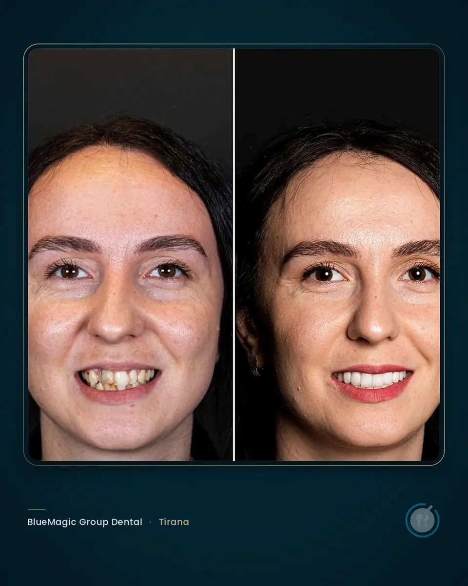 Prima e dopo un trattamento dentale in Albania, paziente reale BlueMagic Group Dental