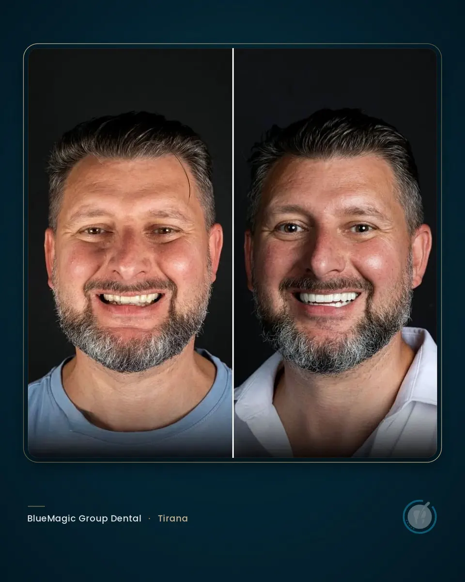 Before and after dental treatment in Albania, real BlueMagic Group Dental patient