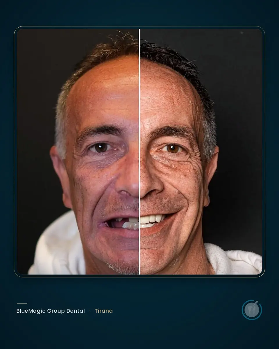 Before and after dental treatment in Albania, real BlueMagic Group Dental patient