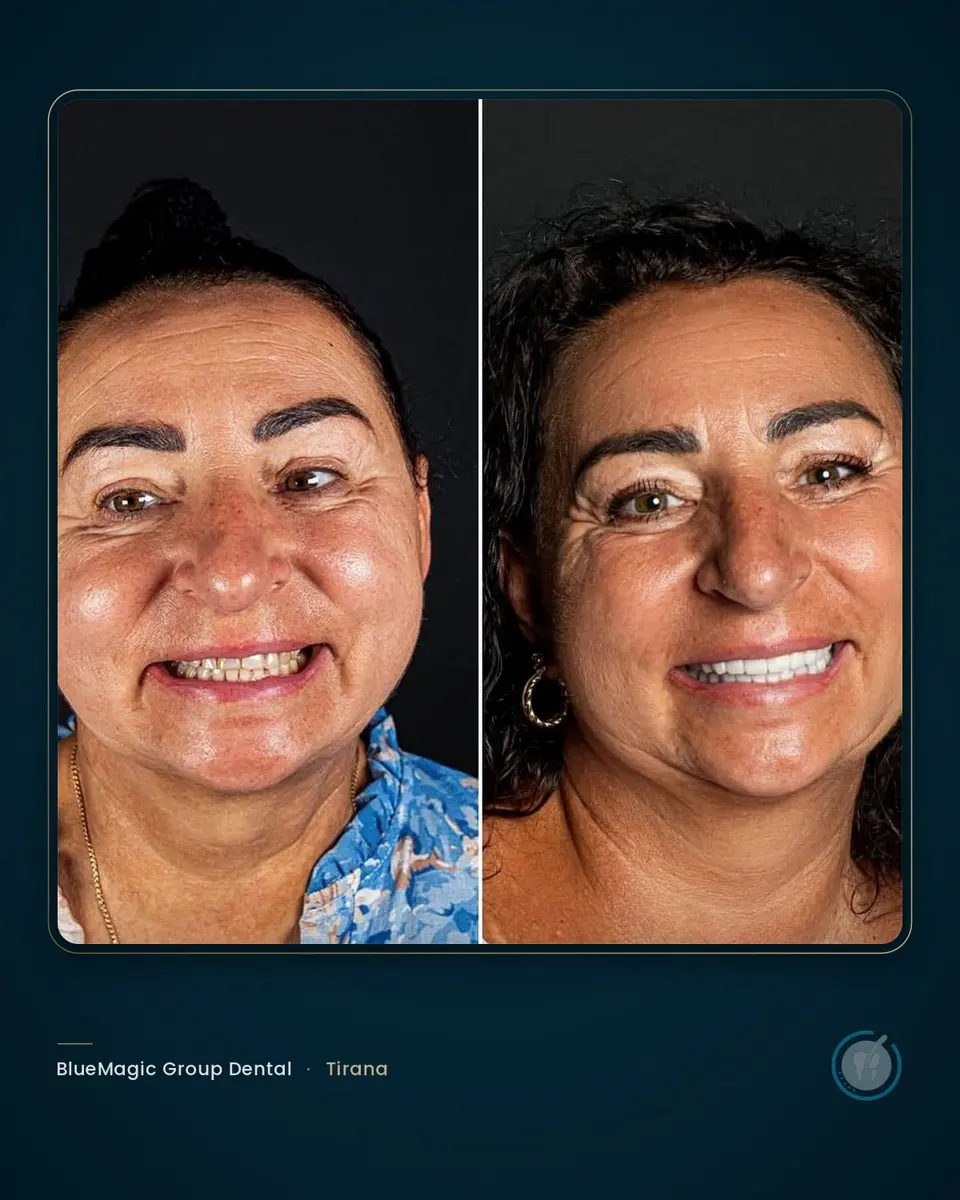 Before and after dental treatment in Albania, real BlueMagic Group Dental patient