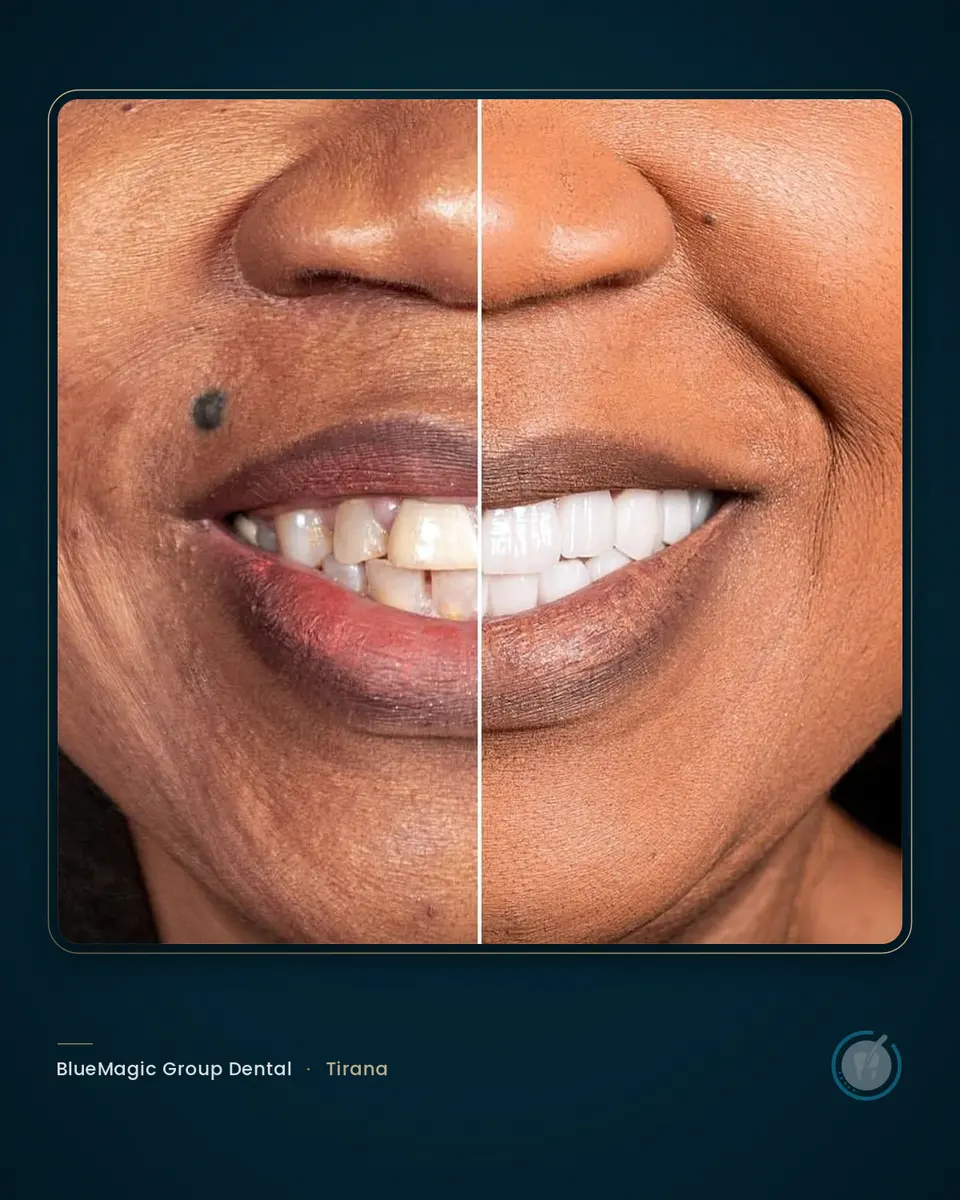 Before and after dental treatment in Albania, real BlueMagic Group Dental patient