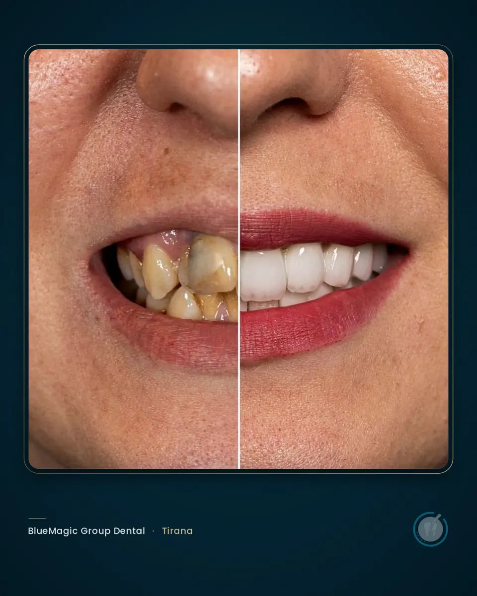 Before and after dental treatment in Albania, real BlueMagic Group Dental patient