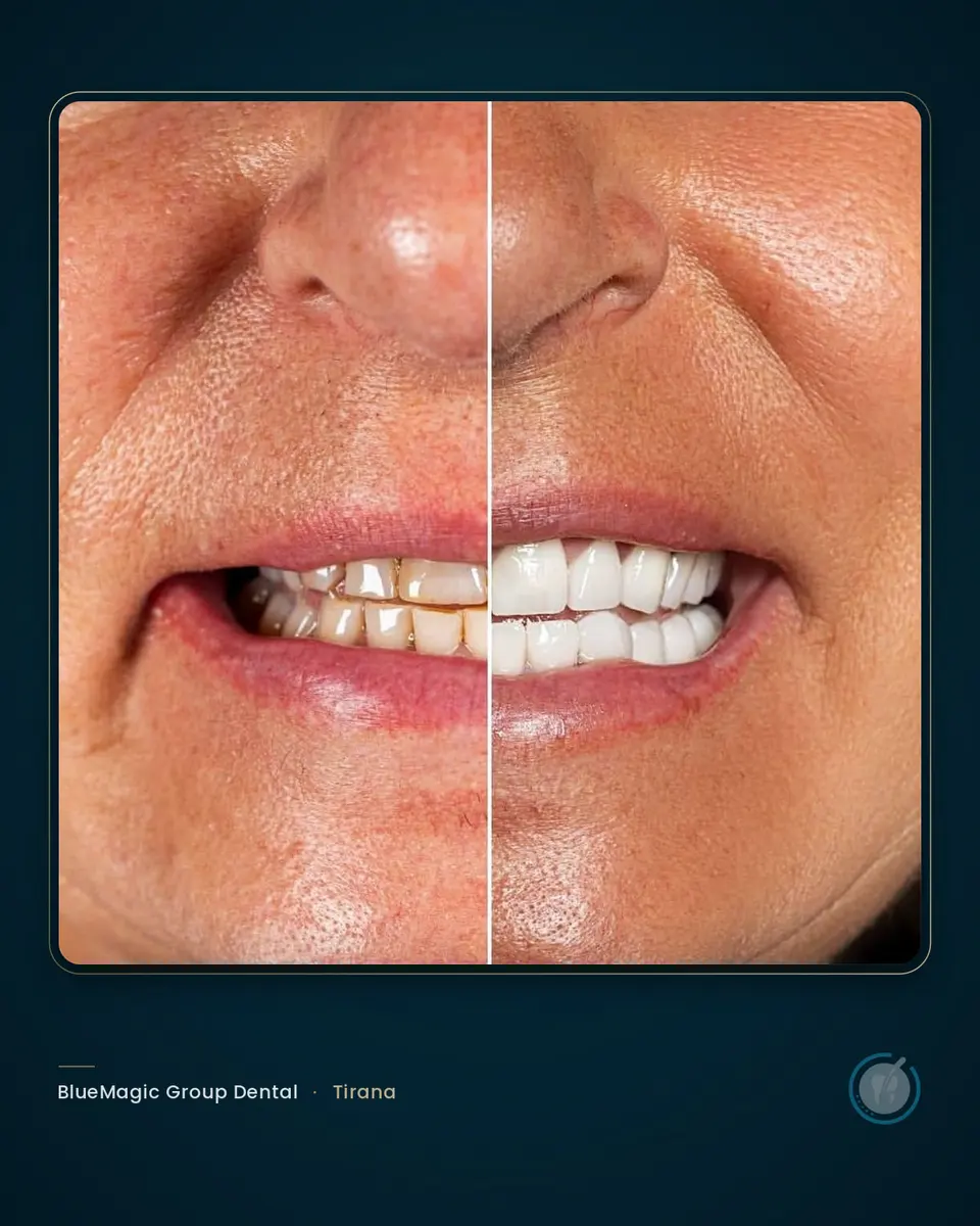 Before and after dental treatment in Albania, real BlueMagic Group Dental patient