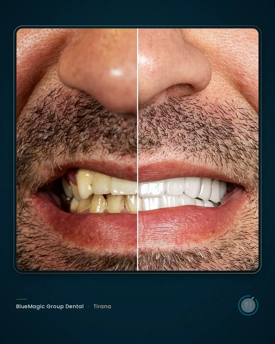 Before and after dental treatment in Albania, real BlueMagic Group Dental patient