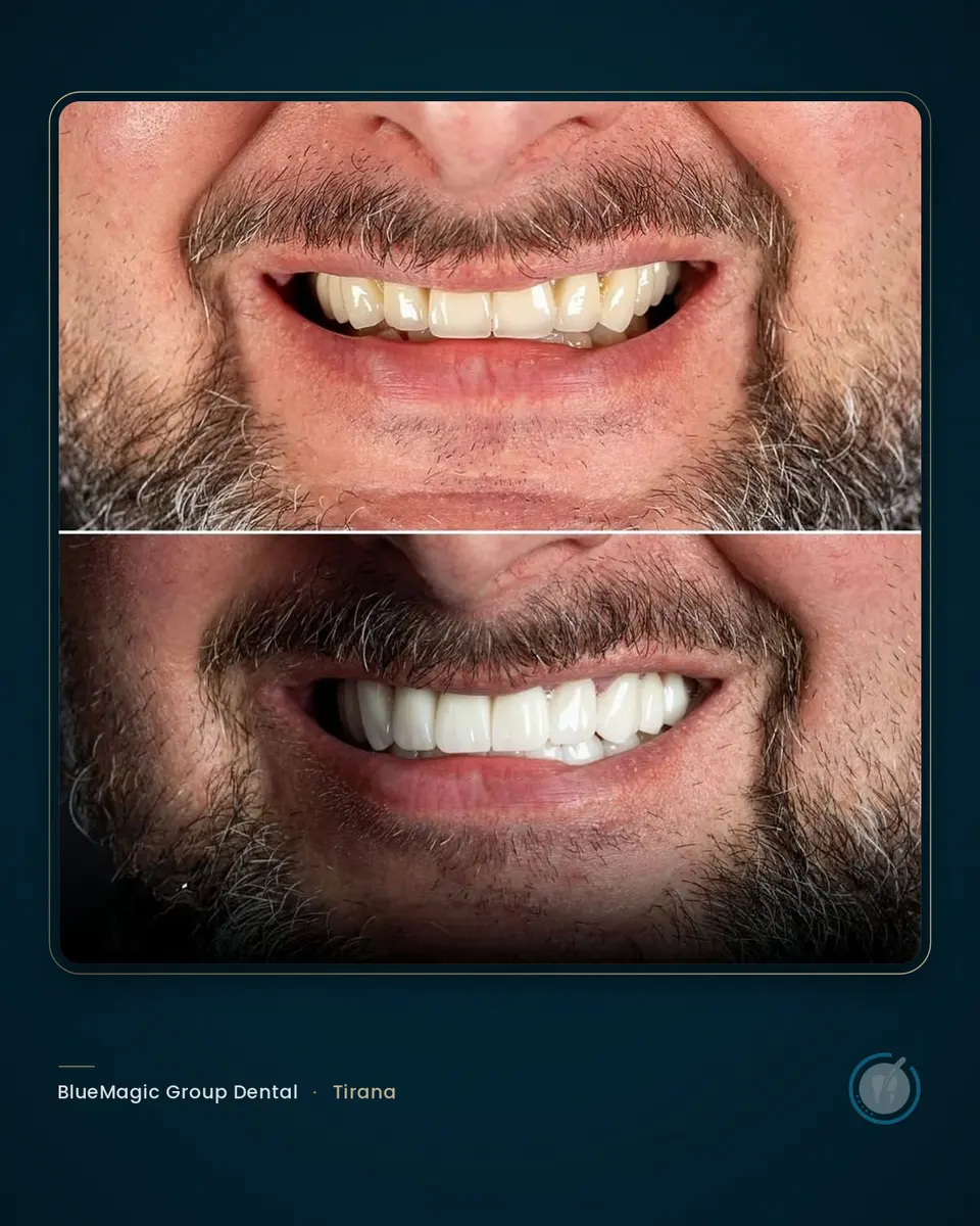 Before and after dental treatment in Albania, real BlueMagic Group Dental patient