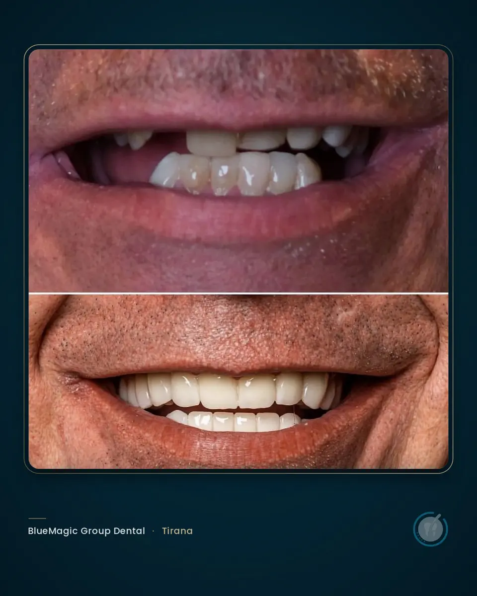 Before and after dental treatment in Albania, real BlueMagic Group Dental patient
