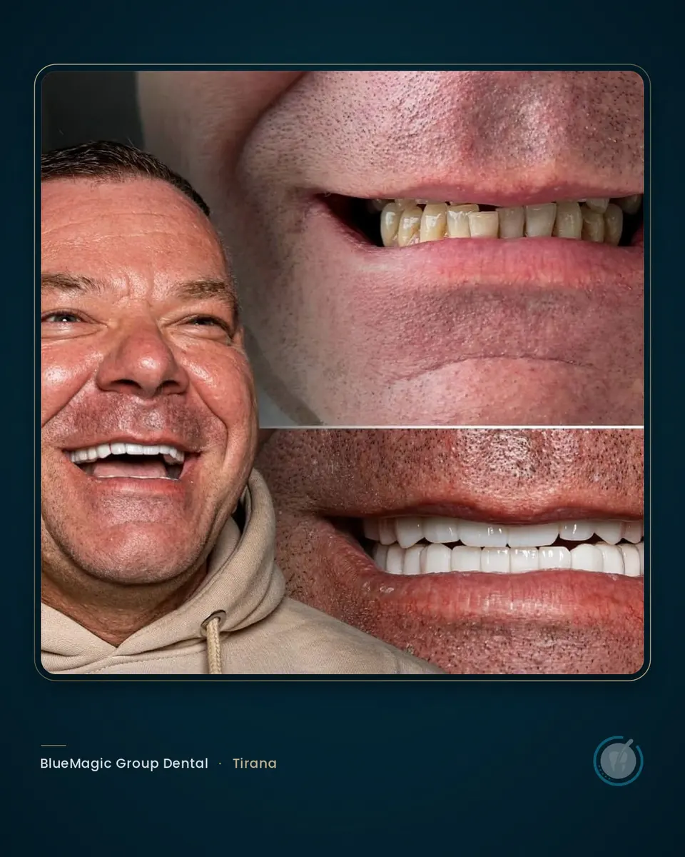 Before and after dental treatment in Albania, real BlueMagic Group Dental patient