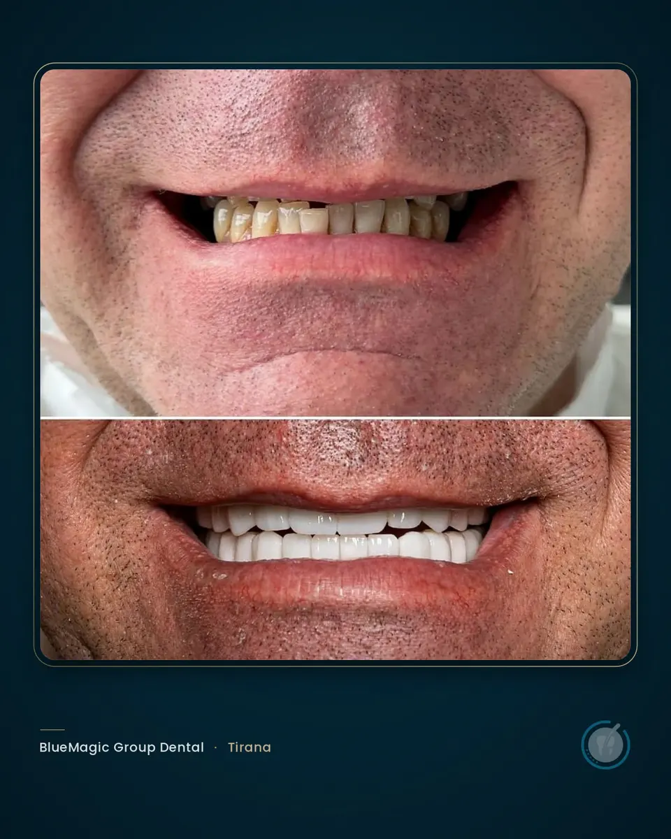 Before and after dental treatment in Albania, real BlueMagic Group Dental patient
