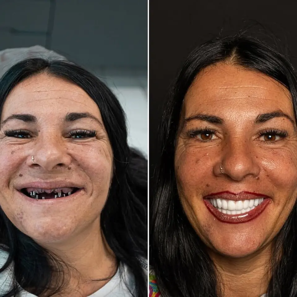 Before and after: Valentina, BlueMagic Group Dental patient