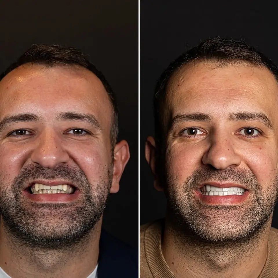 Vorher und nachher: Ilir, behandelt bei BlueMagic Group Dental