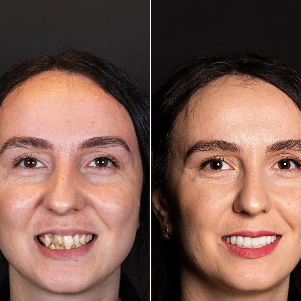 Before and after: Giulia, BlueMagic Group Dental patient