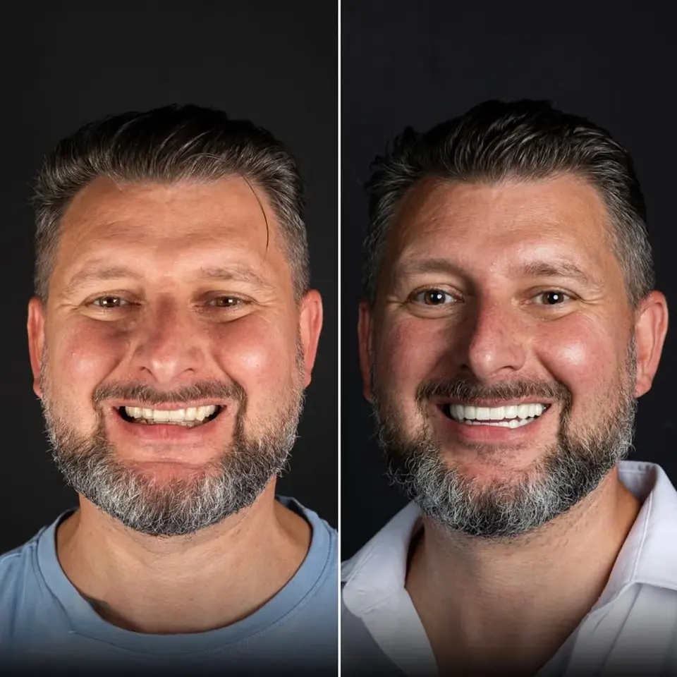 Vorher und nachher: Arben, behandelt bei BlueMagic Group Dental
