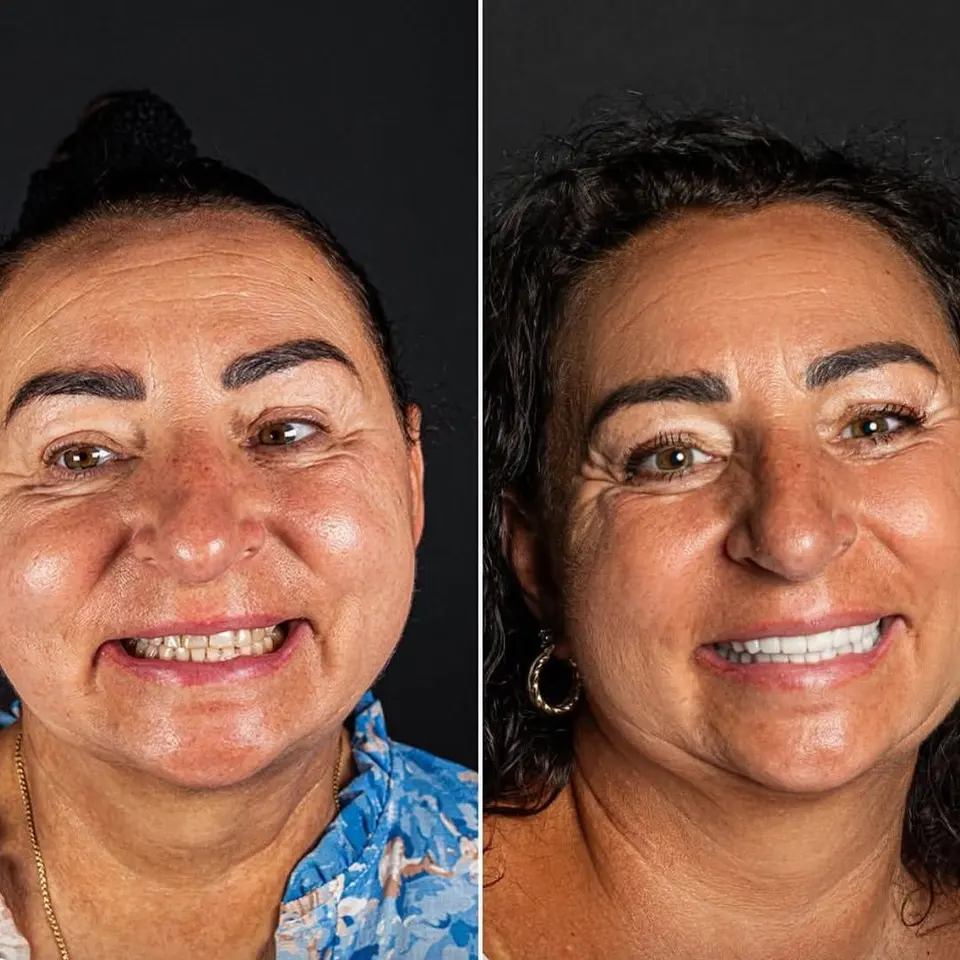 Vorher und nachher: Rosaria, behandelt bei BlueMagic Group Dental