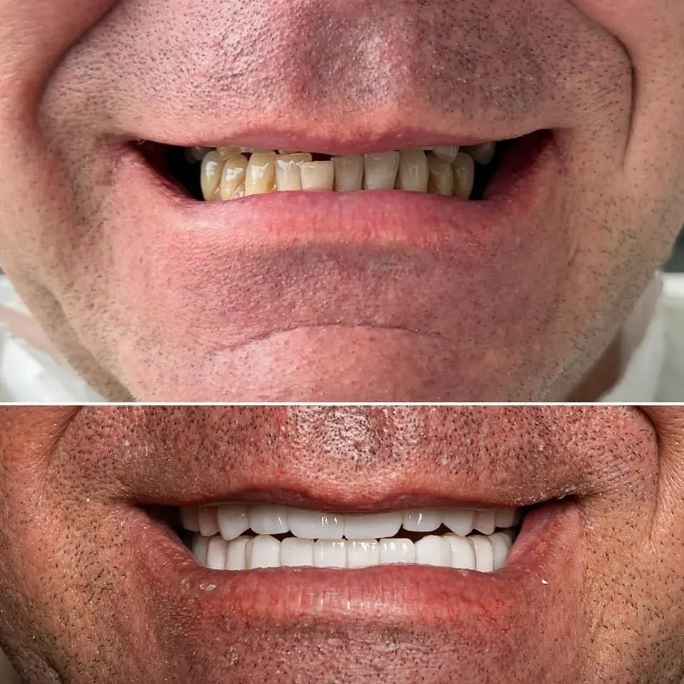 Vorher und nachher: Steve, behandelt bei BlueMagic Group Dental